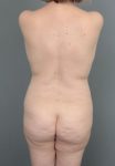 before Brazilian butt lift back view of female patient 6874