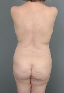 before Brazilian butt lift back view of female patient 6874