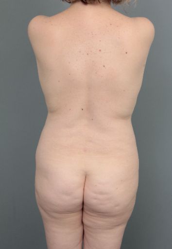 before Brazilian butt lift back view of female patient 6874