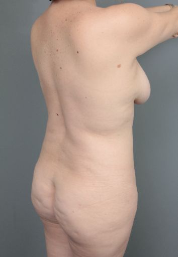 before Brazilian butt lift back right angle view of female patient 6874