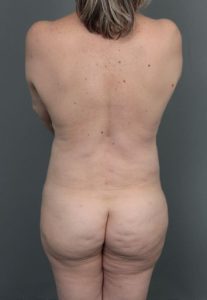 after Brazilian butt lift back view of female patient 6874