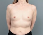before breast augmentation front view of female patient 6842
