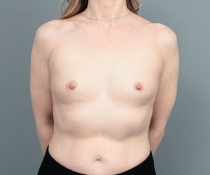 before breast augmentation front view of female patient 6842