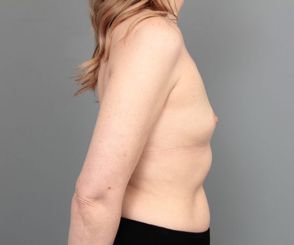 before breast augmentation right side view of female patient 6842
