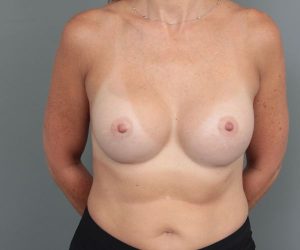 after breast augmentation front view of female patient 6842