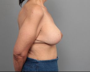 after breast lift with augmentation right side view of female patient 6849