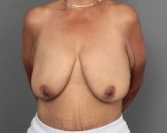 before breast lift with augmentation front view of female patient 6849