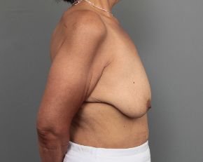 before breast lift with augmentation right side view of female patient 6849