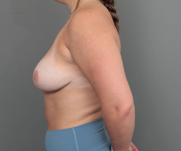 after breast reduction left side view of female patient 6856