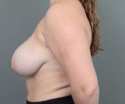 before breast reduction left side view of female patient 6856