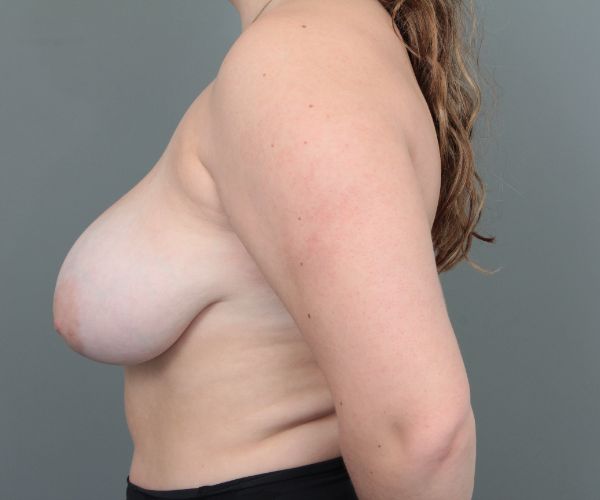 before breast reduction left side view of female patient 6856