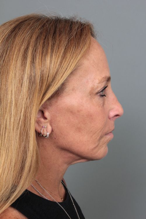 after facelift right side view of female patient 6906