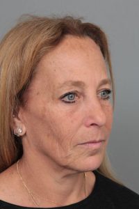 before facelift right angle view of female patient 6906