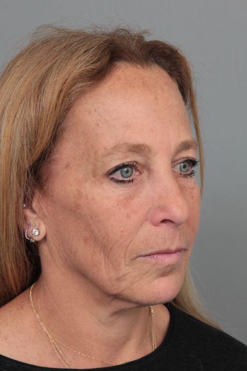 before facelift right angle view of female patient 6906