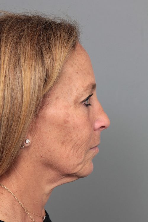 before facelift right side view of female patient 6906
