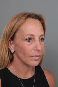 after facelift right angle view of female patient 6906