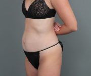 before tummy tuck left angle view of female patient 6886