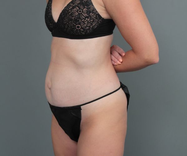 before tummy tuck left angle view of female patient 6886