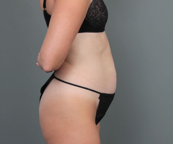 before tummy tuck right side view of female patient 6886