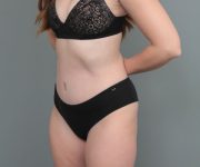 after tummy tuck left angle view of female patient 6886